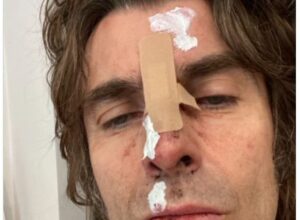“Me caí de un helicóptero”: la impactante foto de Liam Gallagher tras un accidente